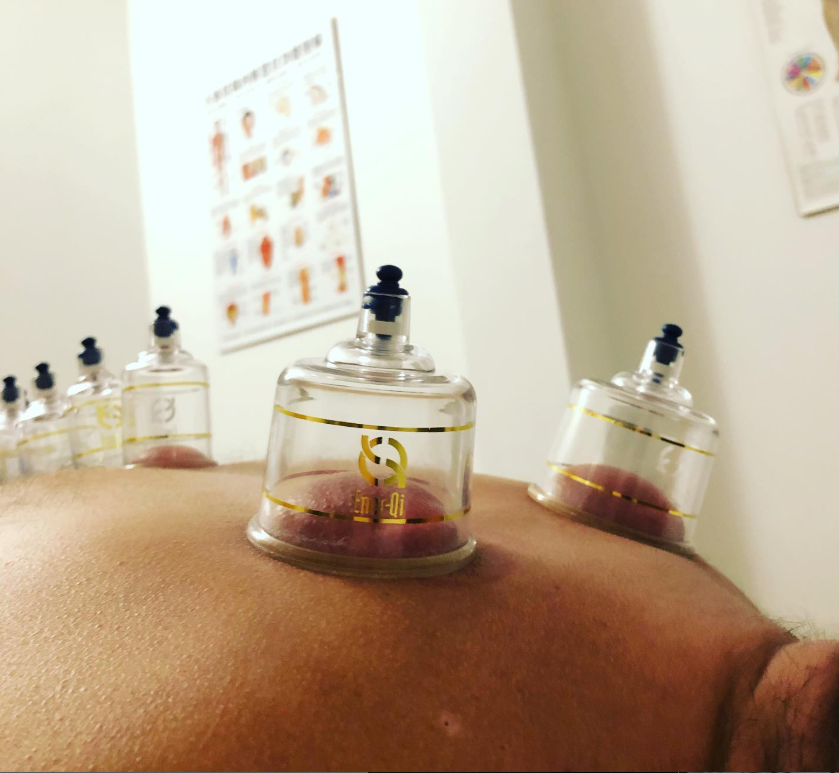 Ventosas (cupping)